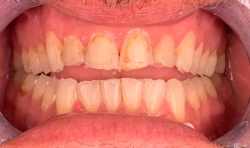 VIP Dental Implants Houston | Board-Certified Periodontist